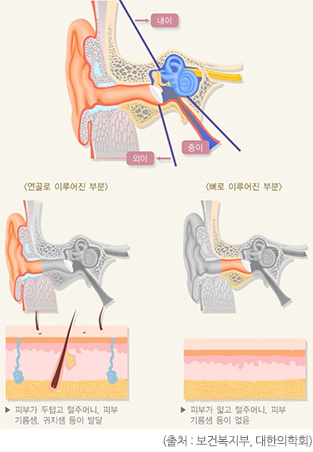 외이질환 설명