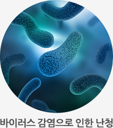 바이러스 감염으로 인한 난청