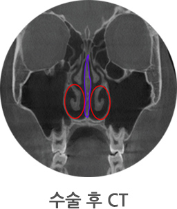 수술 후 CT